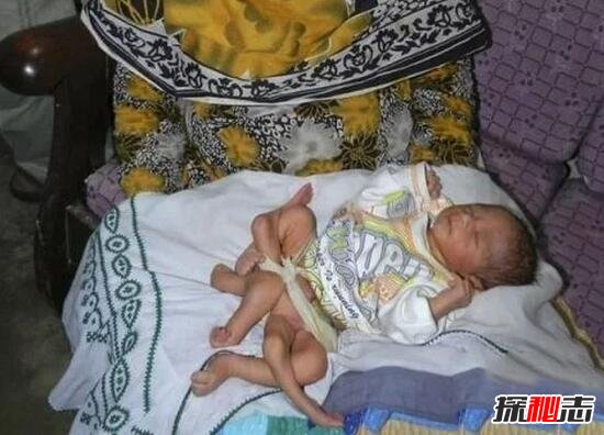 巴基斯坦6条腿的男婴,堂兄妹通婚生6条腿男孩/寄生胎儿